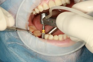 mason-Dental-Implants
