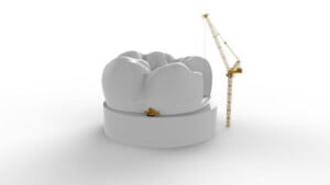 Mason Dentistry - Tooth filling